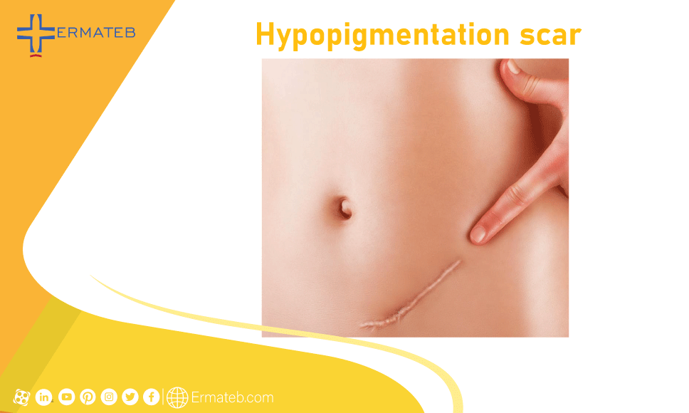 hypopigmentation